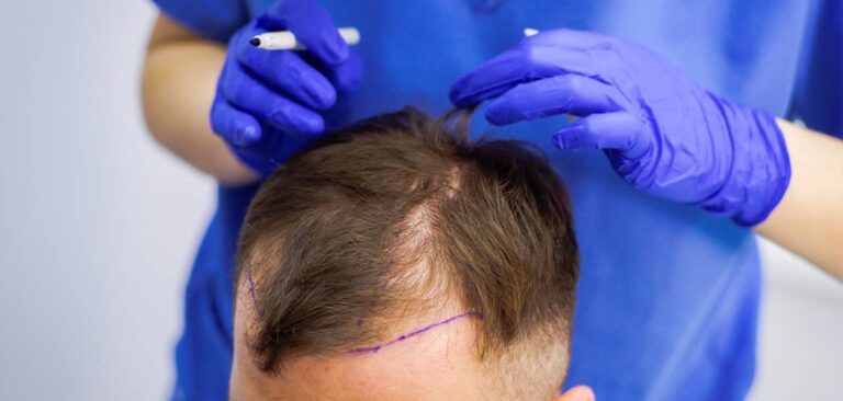 Revolutionizing Hair Restoration: Advanced Solutions for Hair Loss with Crown