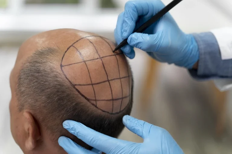 Hair Transplant